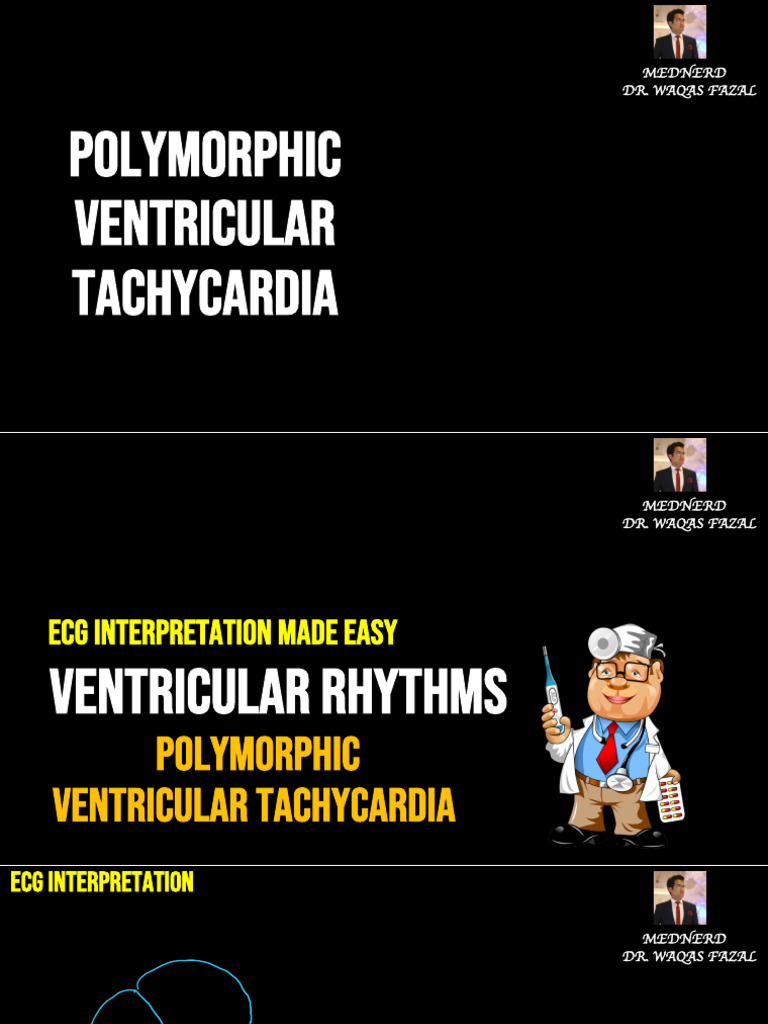 Polymorphic Ventricular Tachycardia ECG Guide | PDF