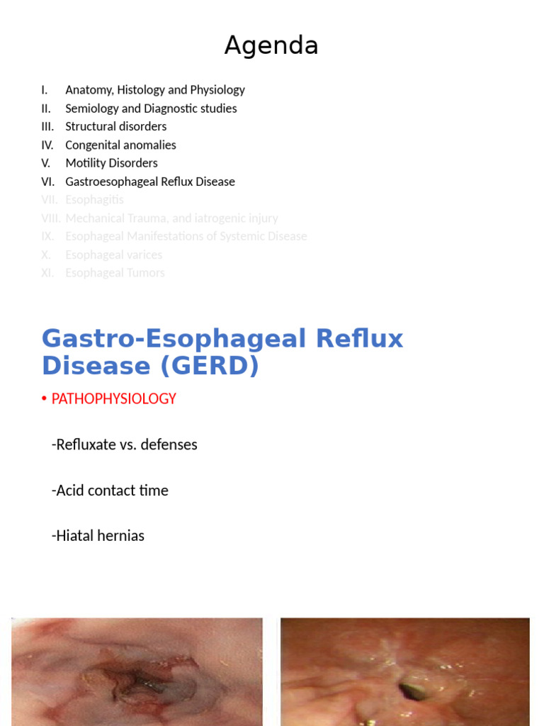 Esophageal Disorders Part 2 | PDF | Esophagus | Gastroesophageal Reflux ...