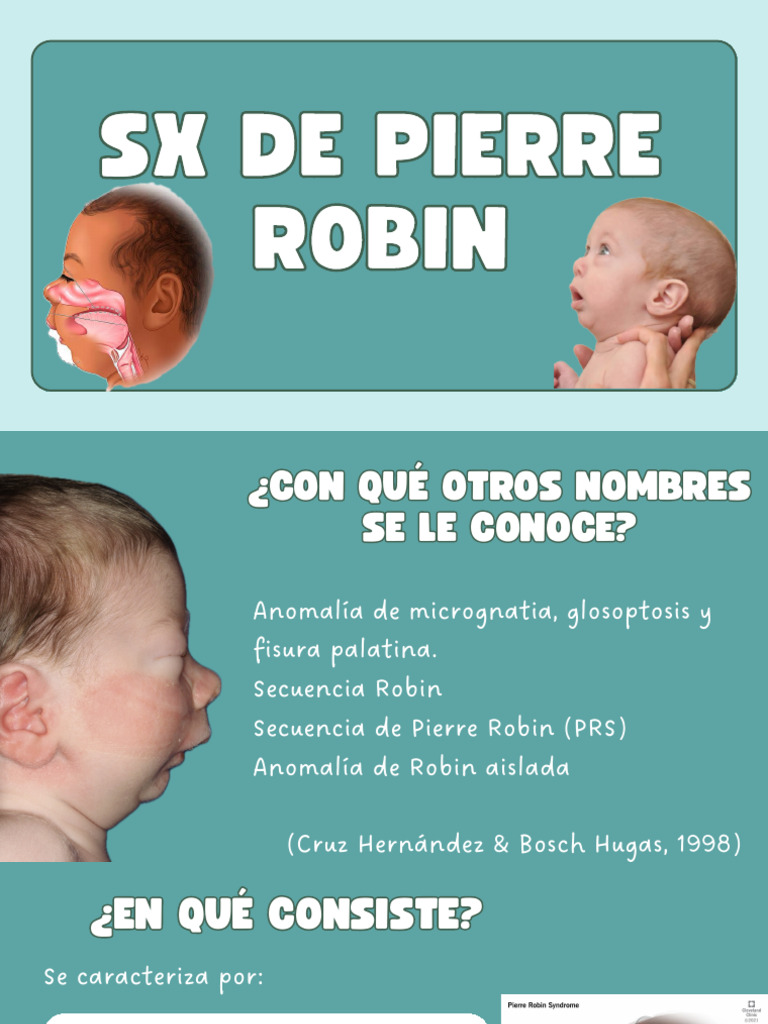 Secuencia de Pierre Robin: Causas y Tratamiento | PDF