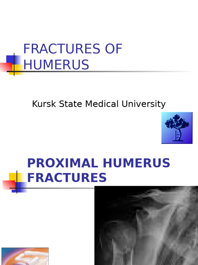 Proximal Humerus Fractures Overview | PDF | Elbow | Shoulder