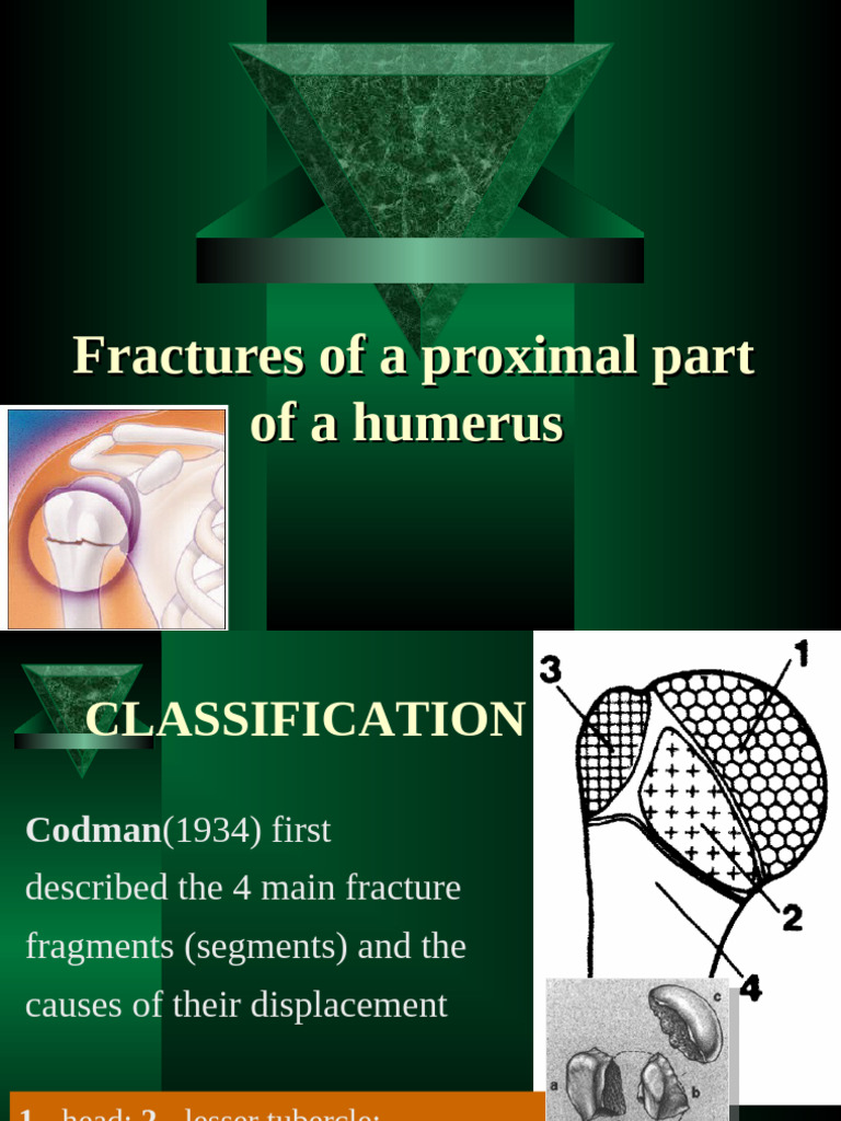 Fractures of Proximal Part's Humerus | PDF