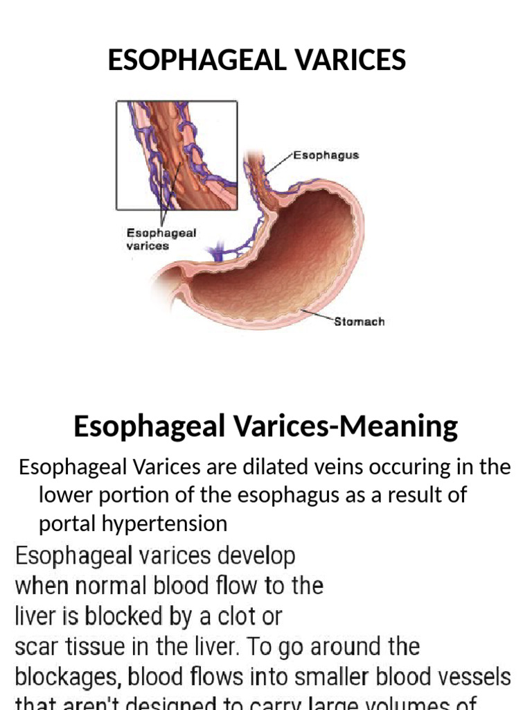 Esophageal Varices | PDF | Cirrhosis | Medical Specialties