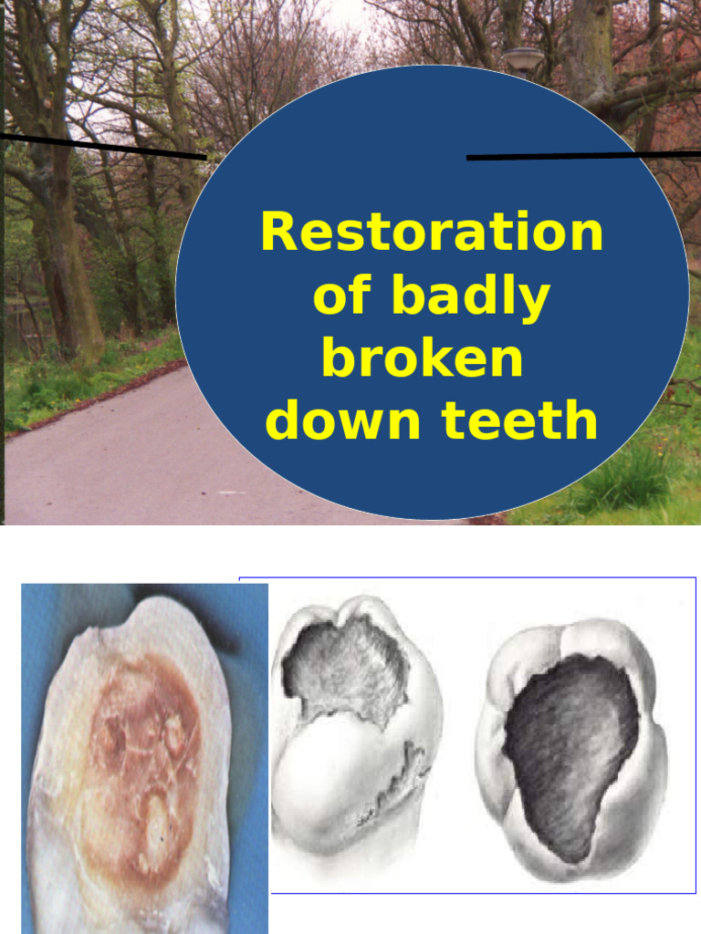 Management of Mutilated Teeth Restoration | PDF | Human Tooth | Dentin