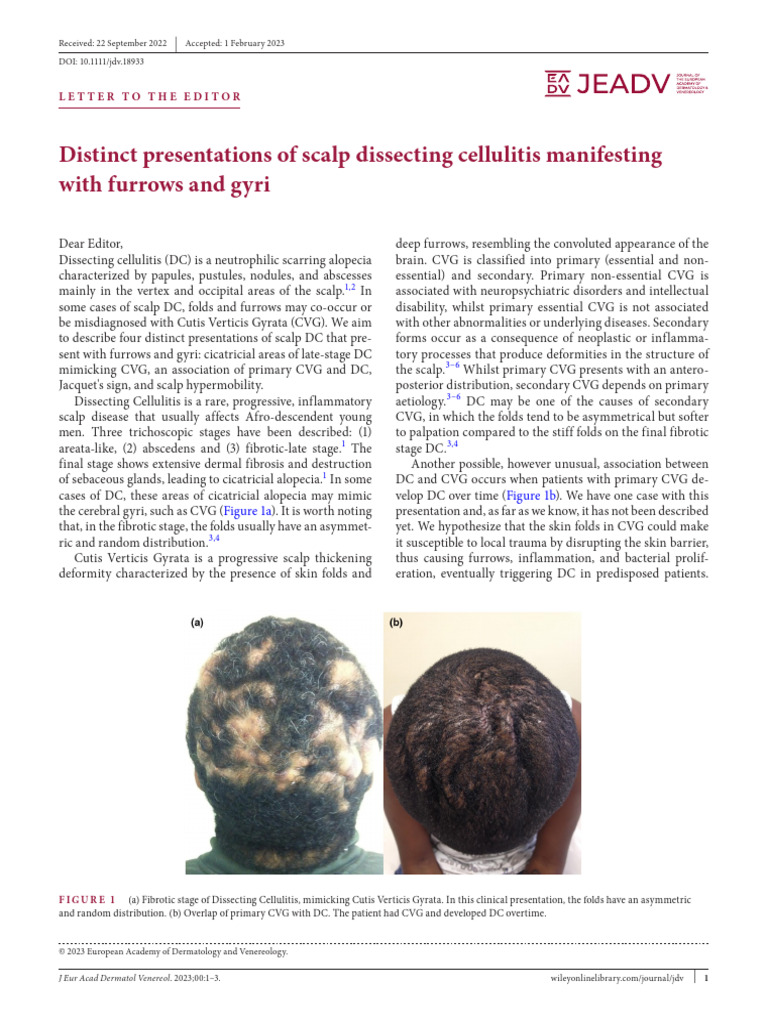 Scalp Dissecting Cellulitis Variants PDF Medical Specialties 