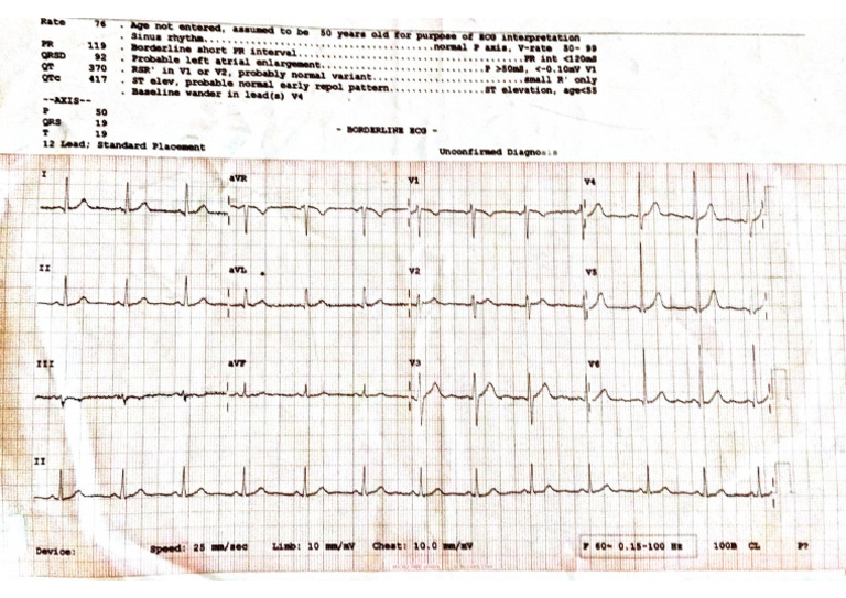 Ecg | PDF