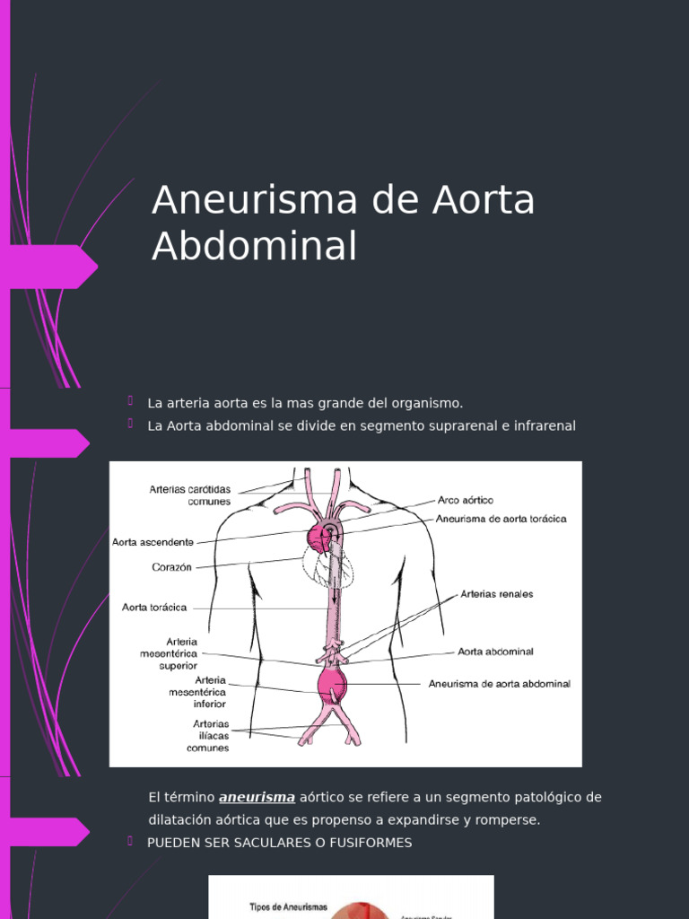 Aneurisma de Aorta Abdominal | PDF | Angiología | Medicina CLINICA