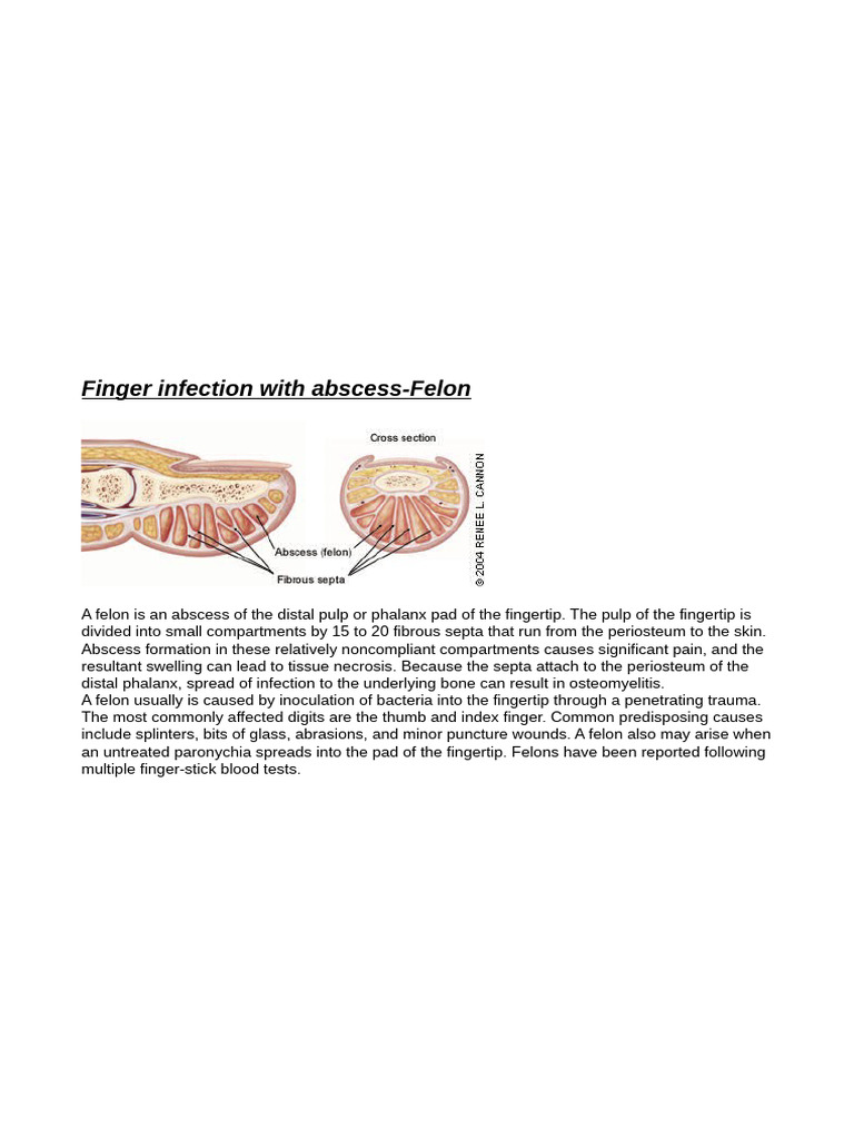 Finger Abscess: Understanding Felons | PDF