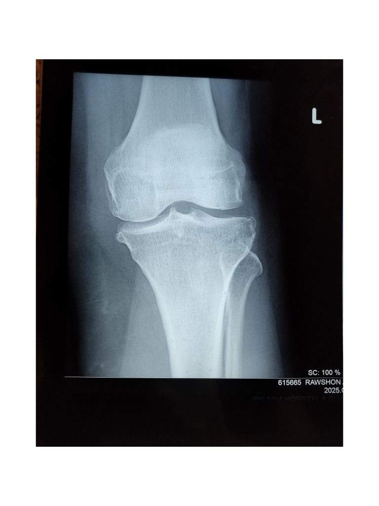 Normal X-ray Findings for Child's Knee | PDF