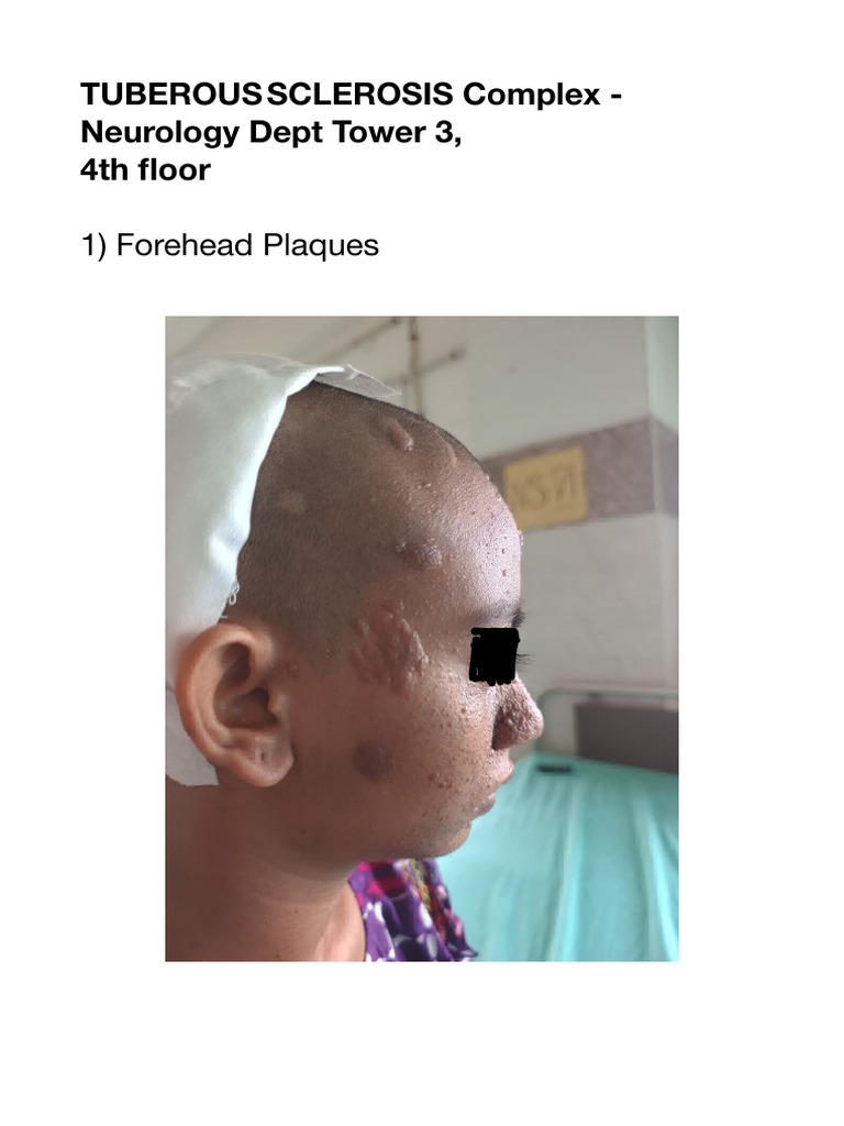 Tuberous Sclerosis Complex Overview | PDF