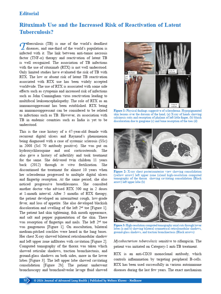 Rituximab Use and the Increased Risk of.2 | PDF | Tuberculosis ...
