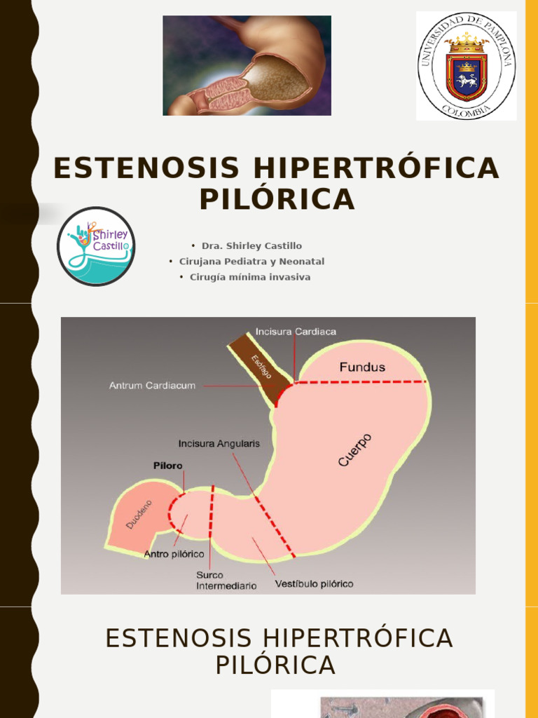 Estenosis Hipertrófica Pilórica 25 | PDF | Examen físico | Estómago