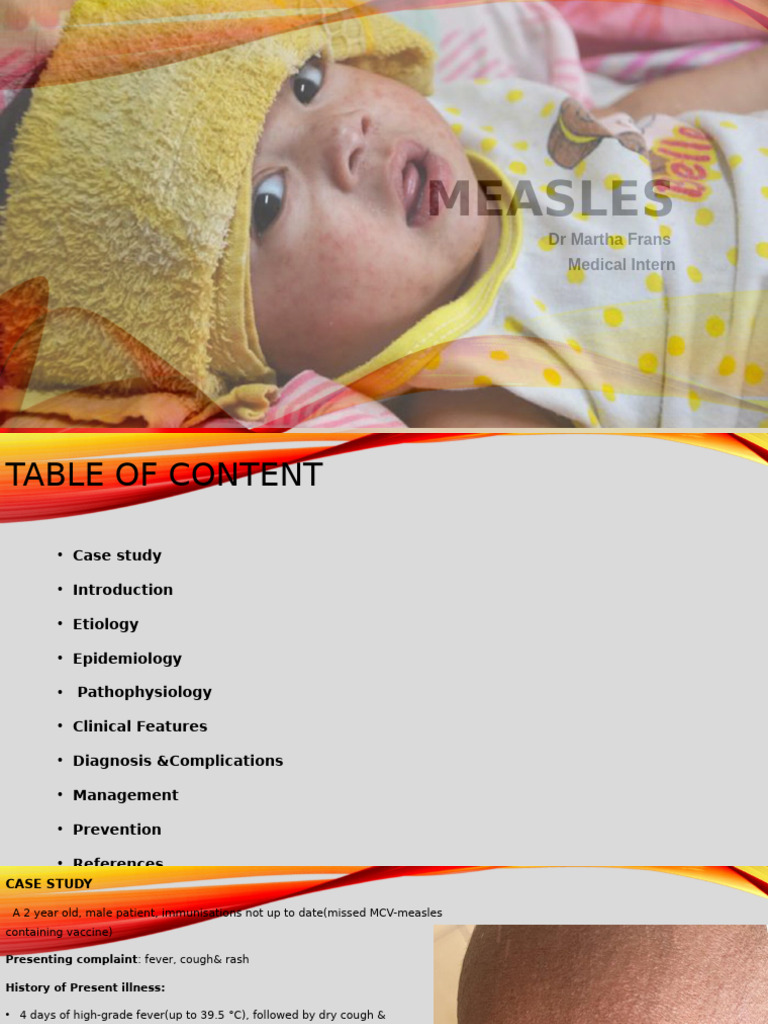 Comprehensive Guide to Measles | PDF | Measles | Vaccines