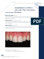 Esthetic Rehabilitation of Worn Anterior Teeth With Thin Porcelain Laminate Veneers