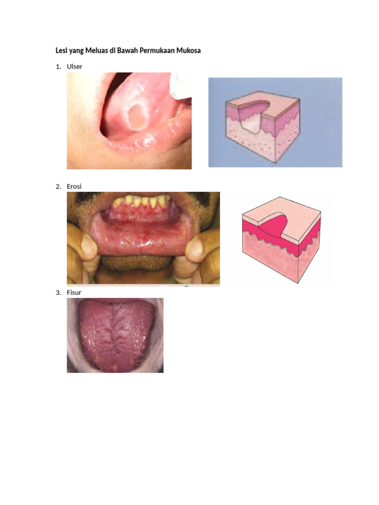 Gambar Jenis Lesi | PDF