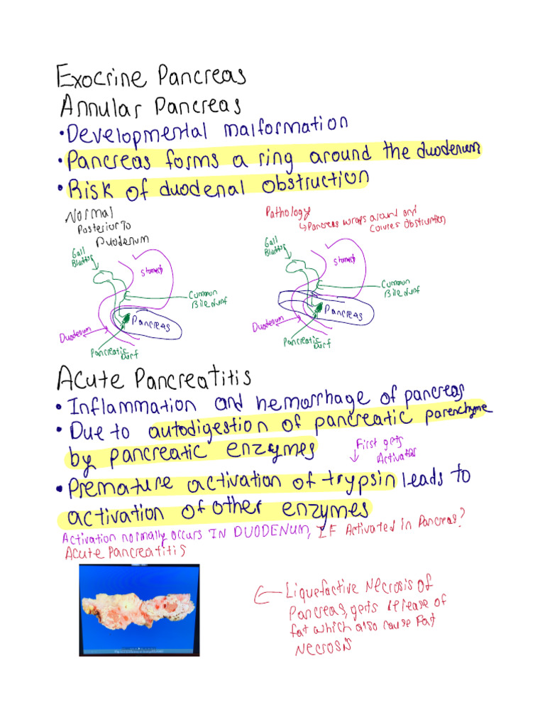 Pathoma 11 Hand Written | PDF | Gallbladder | Pancreas