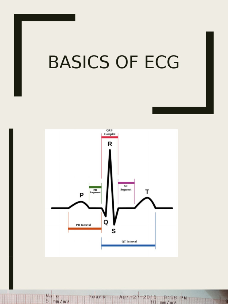 Workshop-Basics of ECG | PDF | Electrocardiography | Myocardial Infarction