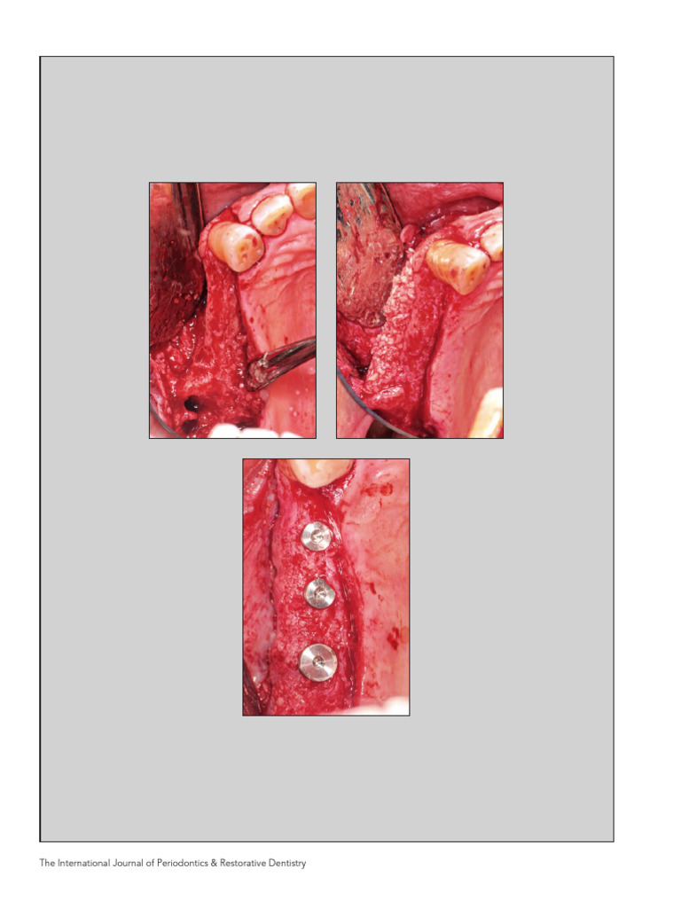 Decision Tree for Ridge Augmentation | PDF | Dental Implant ...