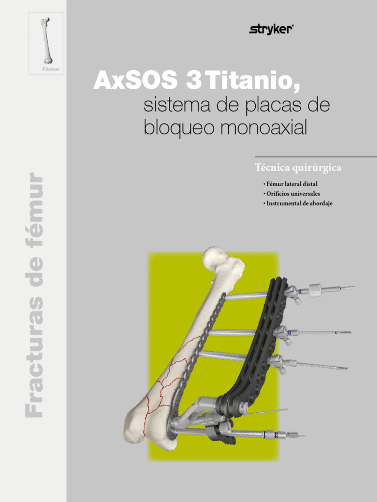 Técnica Quirúrgica para Fémur AxSOS 3 | PDF | Tornillo | Hueso