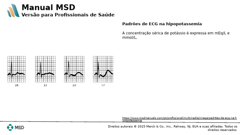 ECG na Hipopotassemia: Padrões e Interpretação | PDF