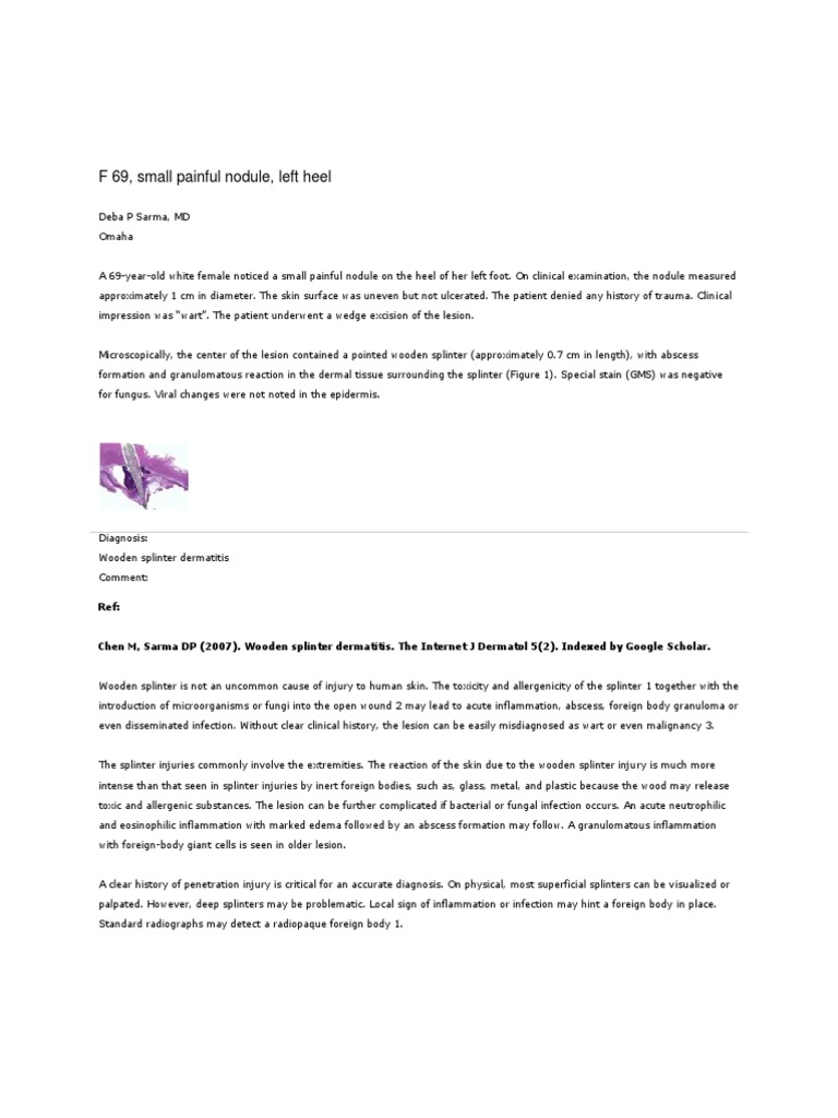 Wooden Splinter Dermatitis PDF Medical Specialties Clinical Medicine