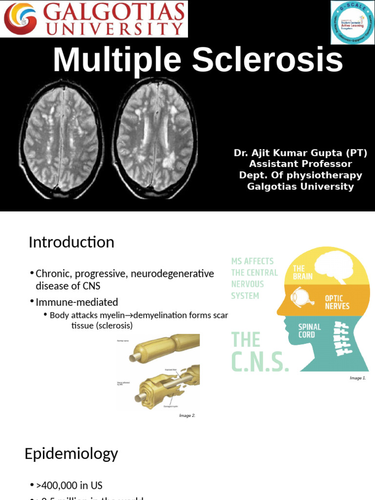 Types of Multiple Sclerosis Overview | PDF | Multiple Sclerosis | Human ...