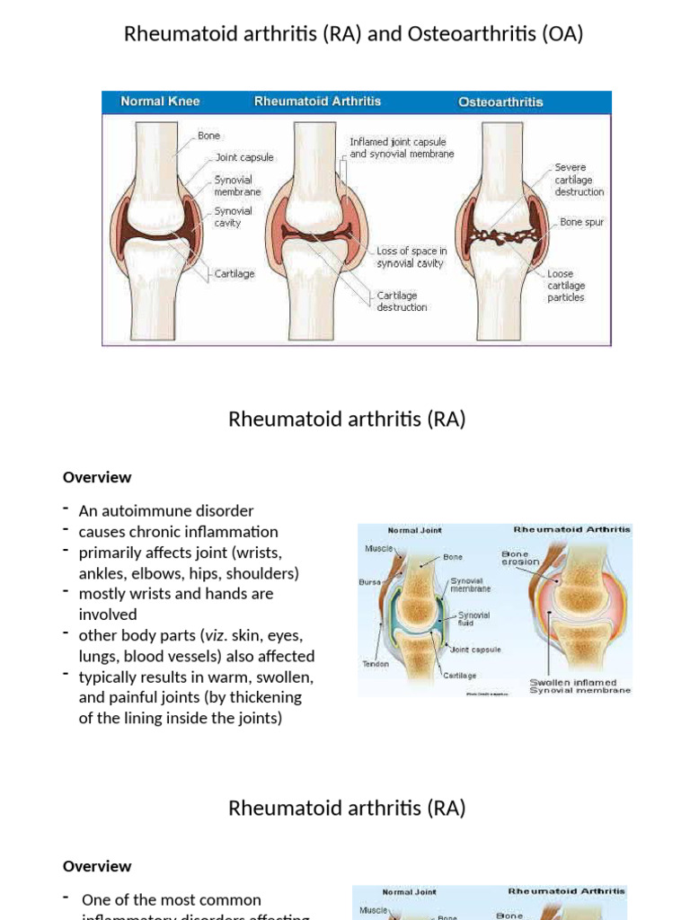 Understanding Rheumatoid Arthritis (RA) | PDF | Rheumatoid Arthritis ...