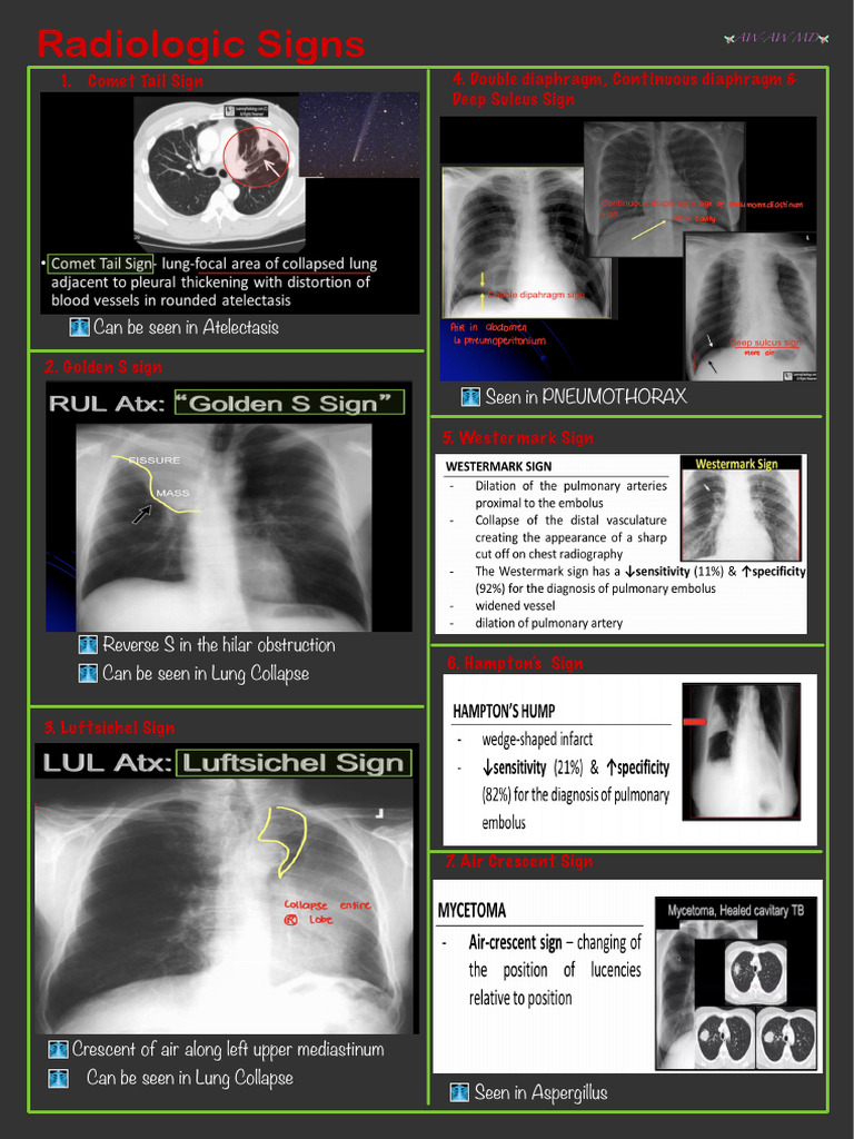 Key Radiologic Signs in Lung Conditions | PDF