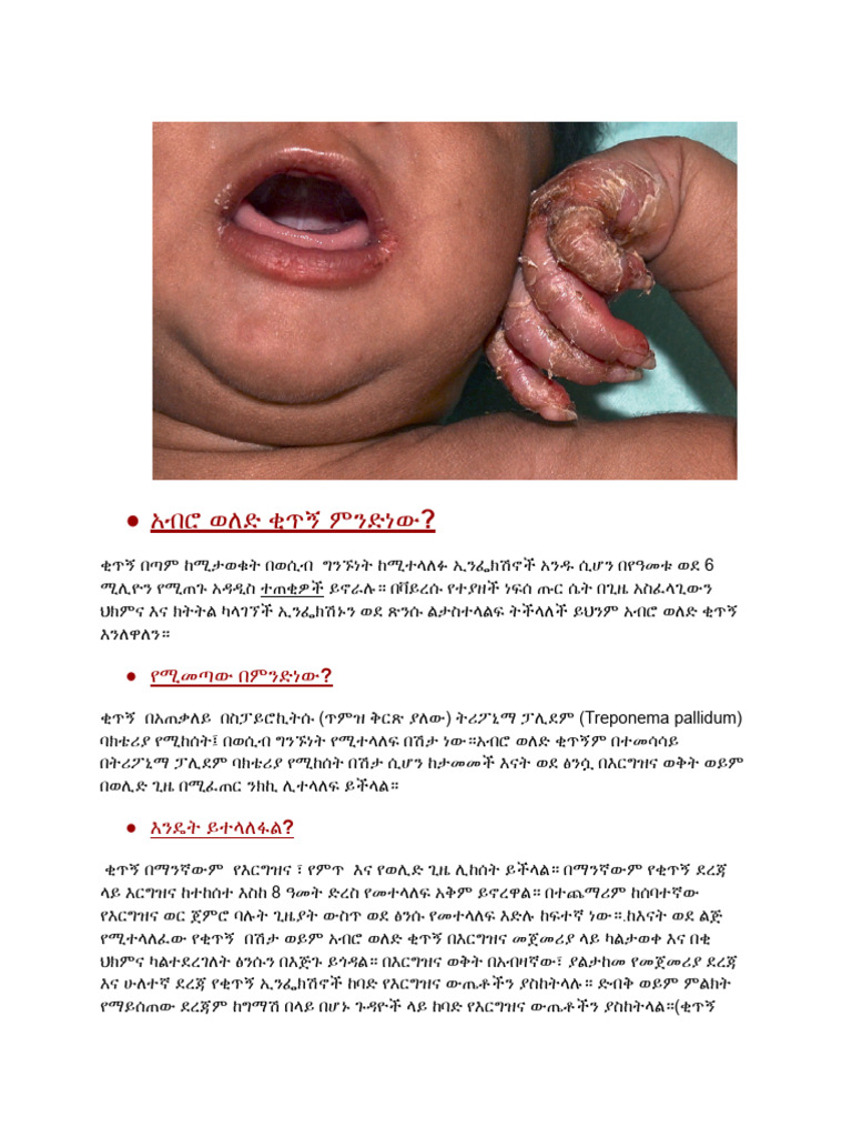 Congenital Syphilis | PDF