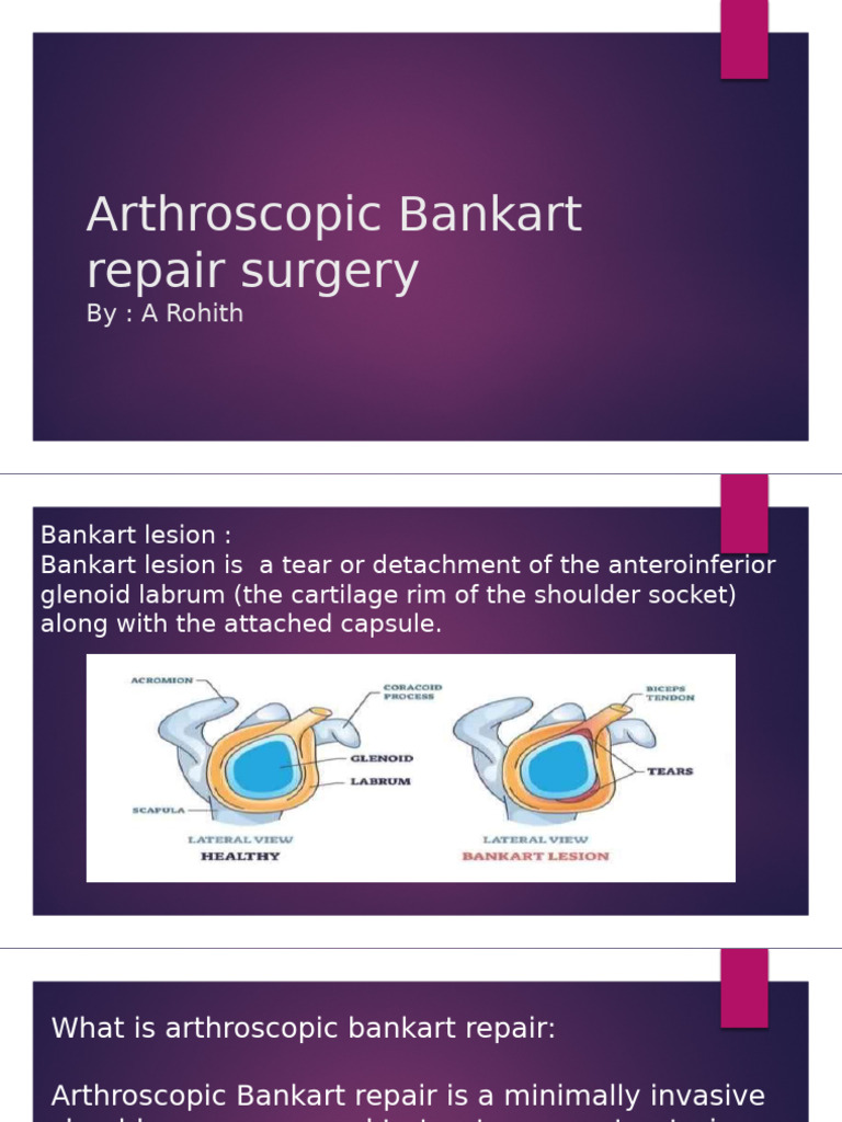 Arthroscopic Bankart Repair Overview | PDF