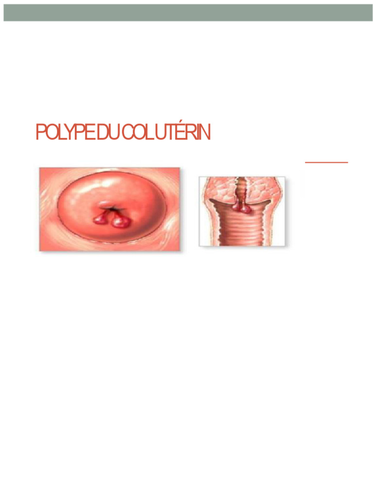 Comprendre les polypes du col utérin | PDF | Utérus | Cycle menstruel