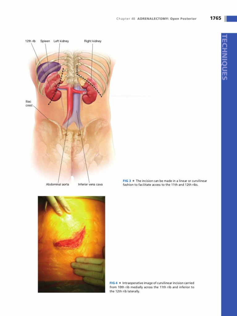 Kidney01 From Operative Techniques in Surgery (2014) | PDF