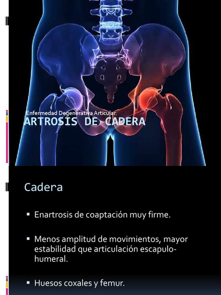 Artrosis de Cadera - Copia | Osteoartritis | Cartílago