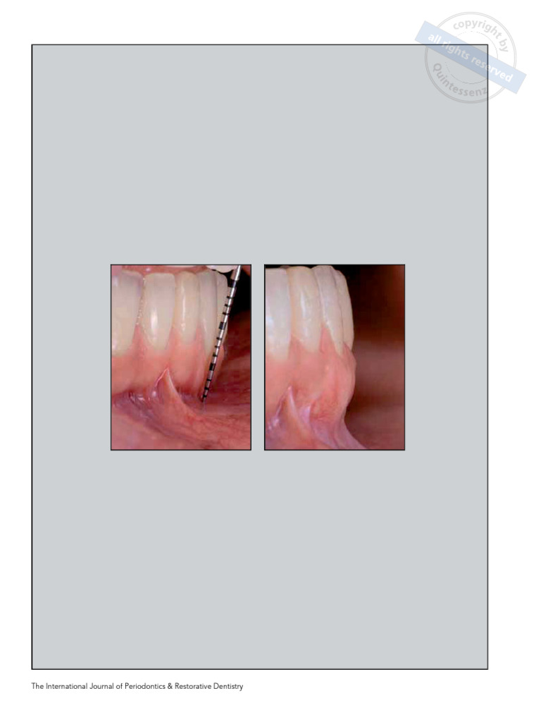 V-CAF Technique for Mandibular Recession Treatment | PDF ...