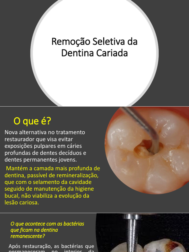 Remoção Seletiva da Dentina Cariada | PDF | Dente humano | Dentina