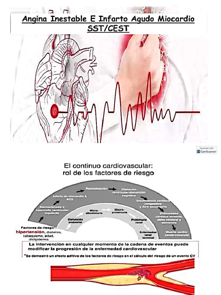 Angina Inestable e Infarto Agudo Miocard | PDF