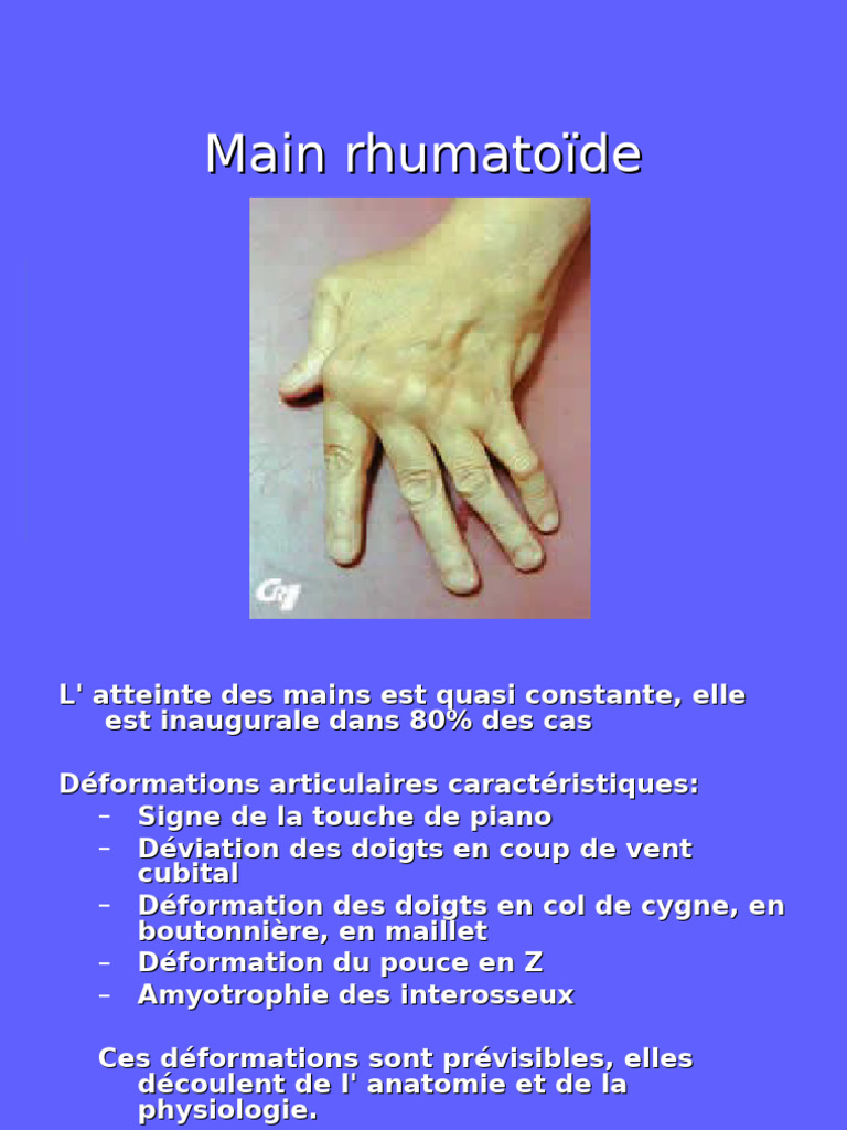 Déformations de la main rhumatoïde | PDF | Main | Corps humain