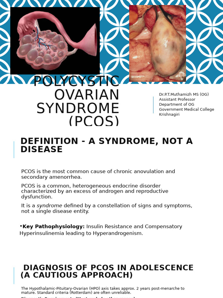 Polycystic Ovarian Syndrome (PCOS) | PDF | Polycystic Ovary Syndrome ...