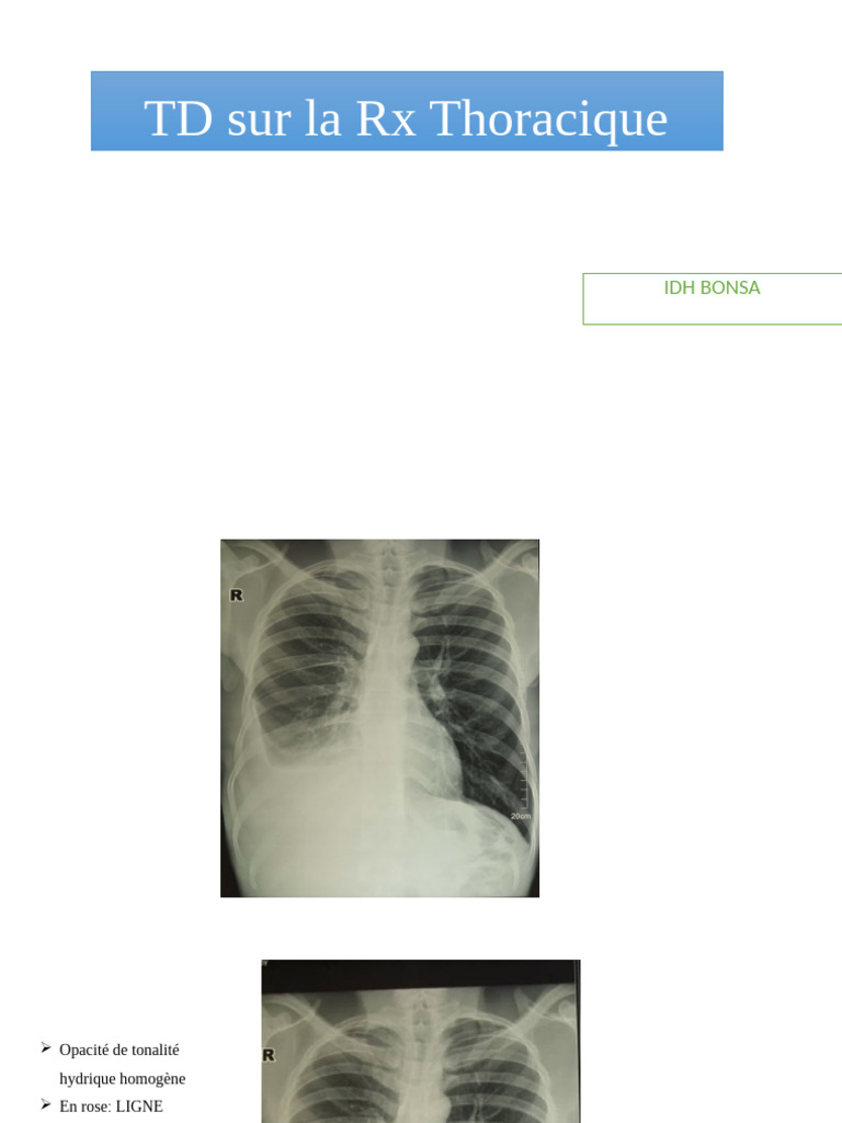 RX Thoracique | PDF