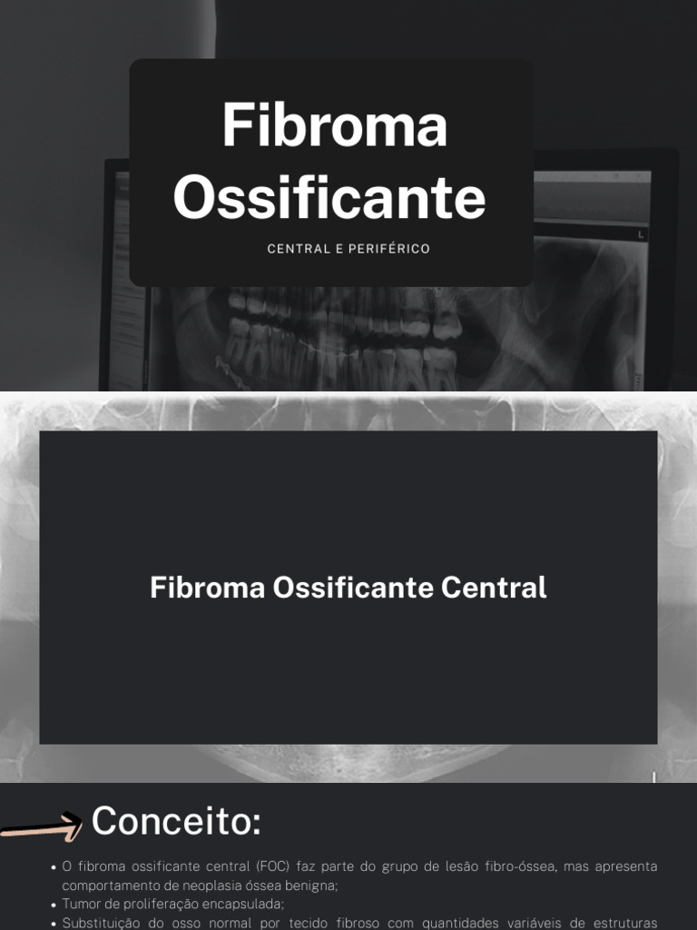 Fibroma Ossificante Periférico: Características e Tratamento | PDF ...