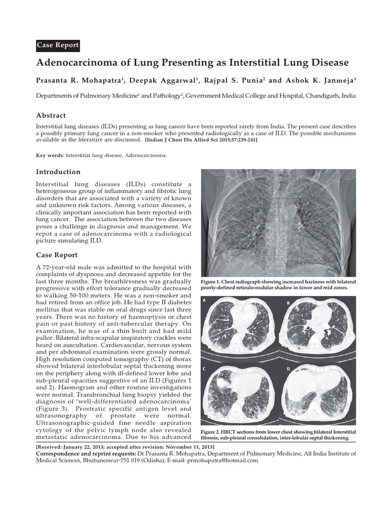 Lung Cancer Mimicking Interstitial Lung Disease | PDF | Lung Cancer ...