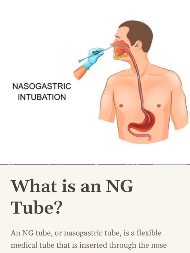 NG Tube Presentation | PDF