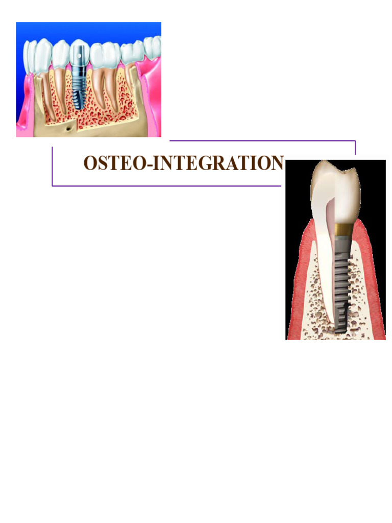 Understanding Osseointegration in Implants | PDF | Dental Implant | Bone