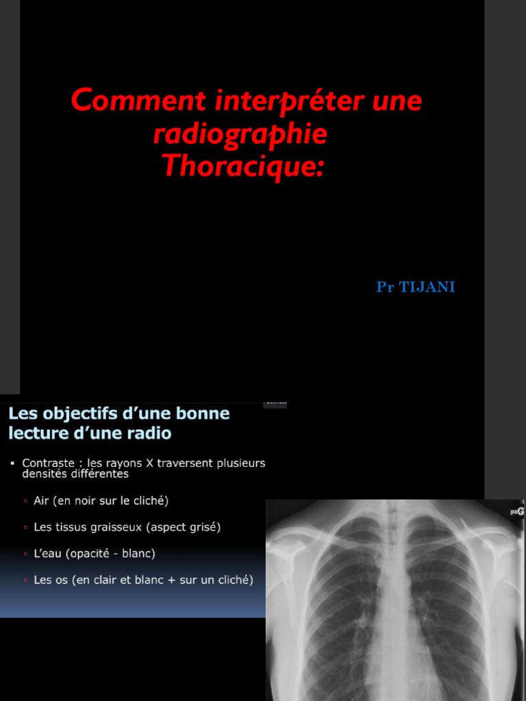 Interprétation d'une radiographie thoracique | PDF