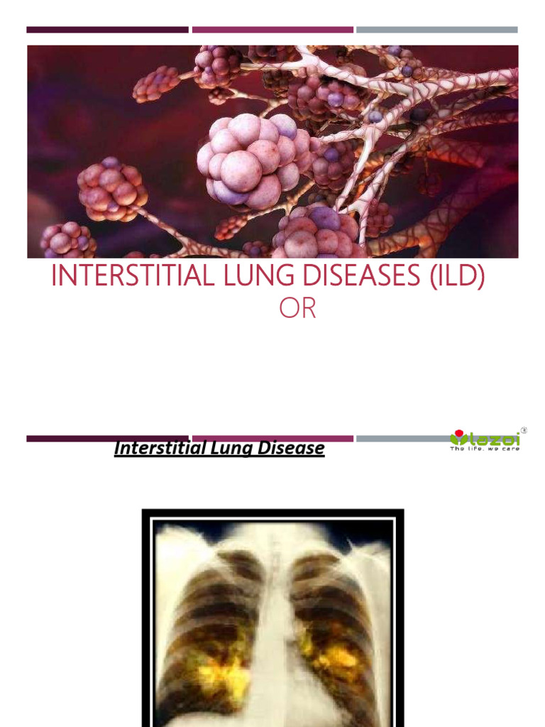 Understanding Interstitial Lung Disease (ILD) | PDF | Lung ...