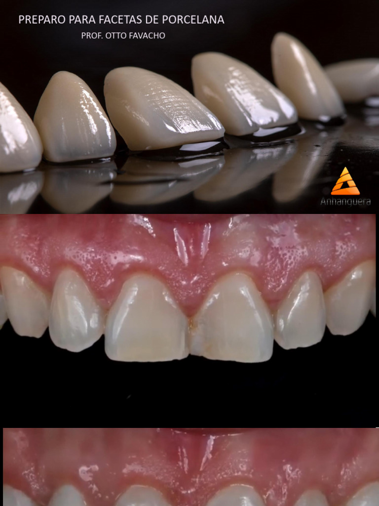 Aula Facetas de Porcelana | PDF