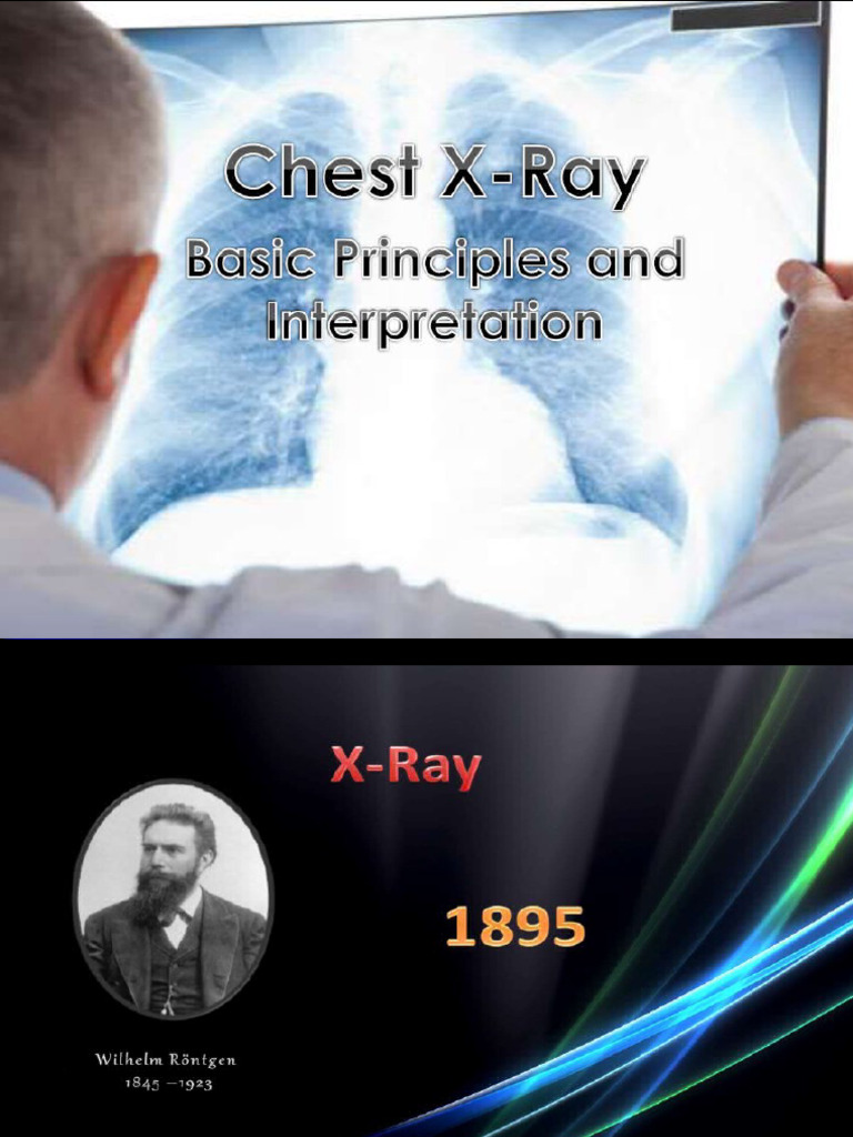Chest X Ray Made Simple | PDF | Thorax | Lung
