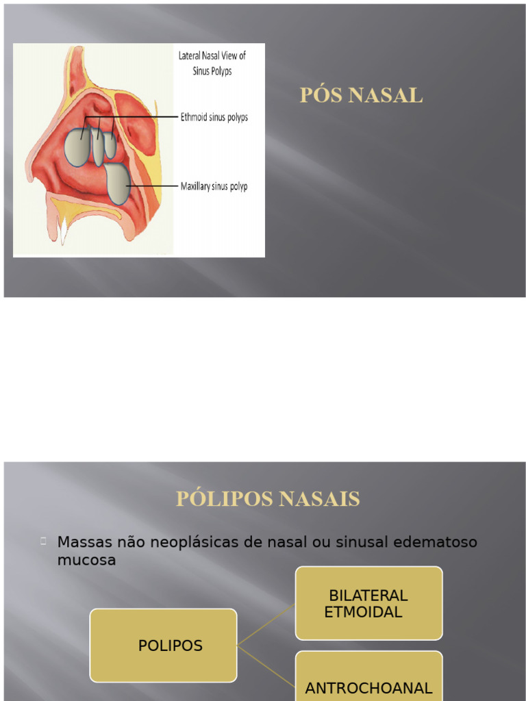 Pólipo Nasal | PDF | Otorrinolaringologia | Medicina Clínica