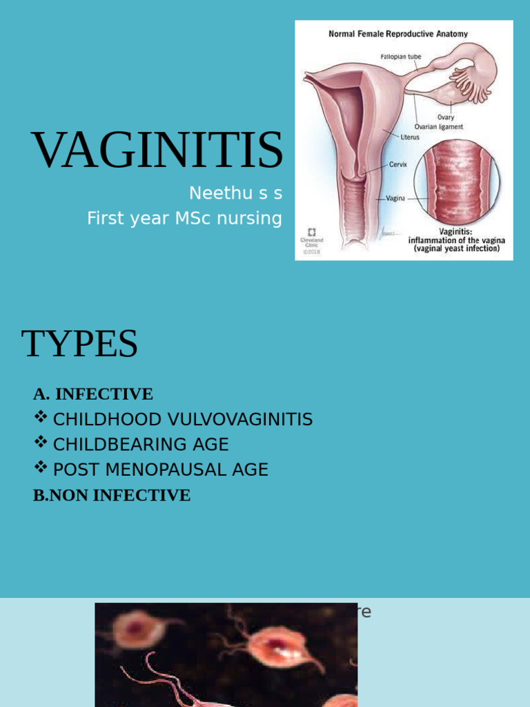 Comprehensive Guide to Vaginitis Types | PDF | Medical Specialties ...