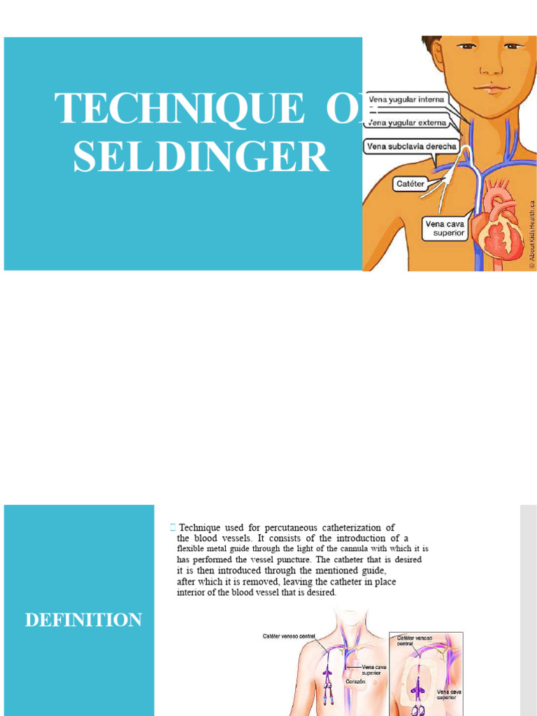 Seldinger Technique | PDF | Catheter | Intravenous Therapy