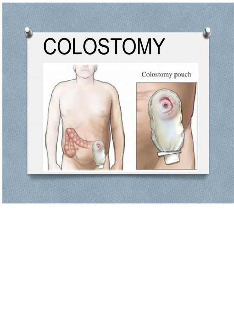 Colostomy | PDF | Large Intestine | Abdomen